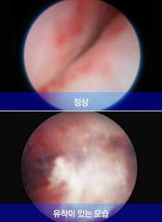 디스크 탈출로 인한 유착