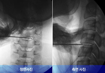 탈출된 디스크에 바늘이 정확히 삽입된 모습