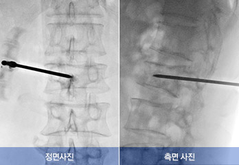 안전하게 바늘이 삽입된 모습