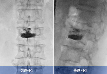 골시멘트가 주입된 모습