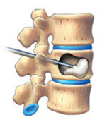 척추체내로 골시멘트 주입